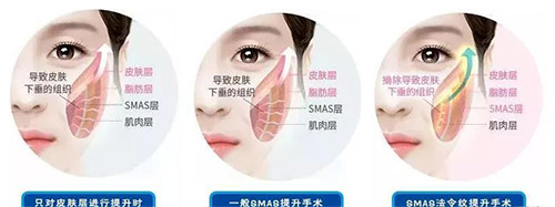 三类拉皮提升手术方法对比