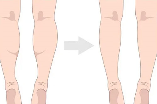 吸脂瘦小腿