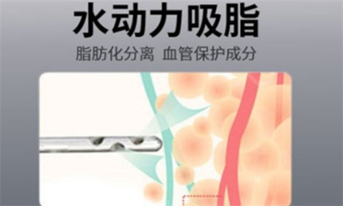 水动力吸脂