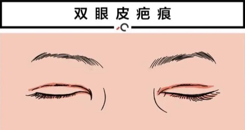 双眼皮疤痕修复动画图