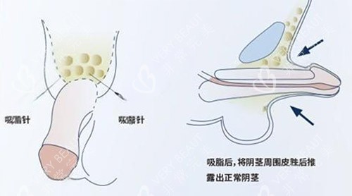 吸脂增大阴茎照片