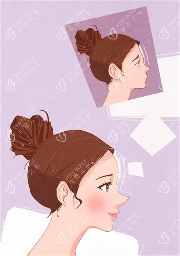 額部填充整形手術(shù)