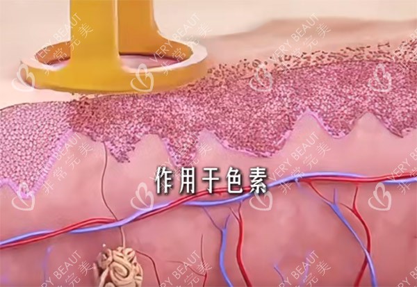 調(diào)Q激光手術(shù)示意圖
