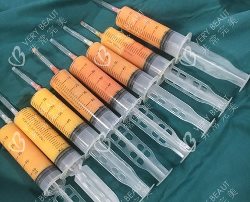 吸脂手術(shù)抽出來的脂肪照片