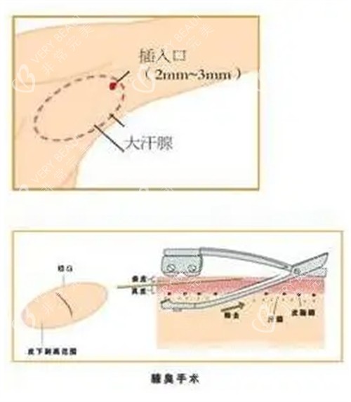 腋臭手術過程圖解