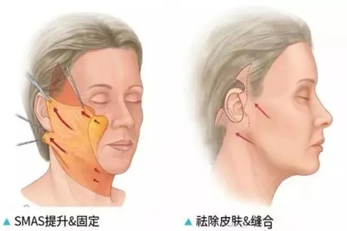 拉皮手術