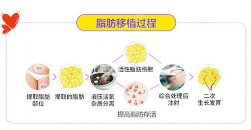 脂肪移植過程