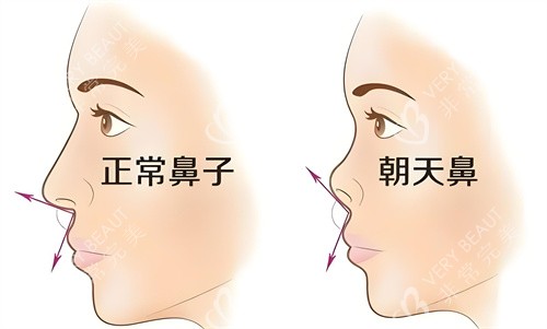 正常鼻子與朝天鼻對比動畫圖
