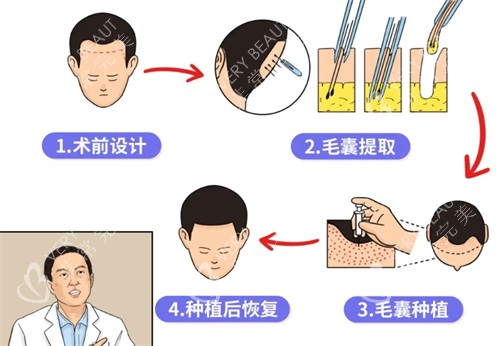 植發(fā)手術(shù)的流程操作圖