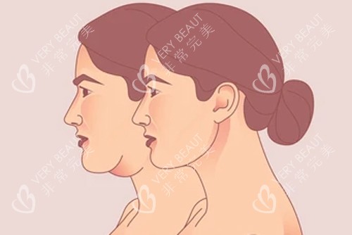 頸部拉皮變成天鵝頸