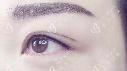雙眼皮實(shí)拍