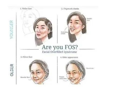 饅化臉示意圖