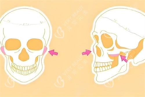 顴骨手術磨骨部位骨頭演示動畫圖