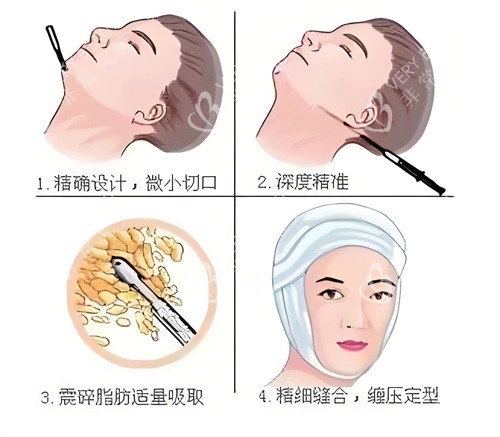 面部吸脂手術(shù)過(guò)程演示動(dòng)畫(huà)圖