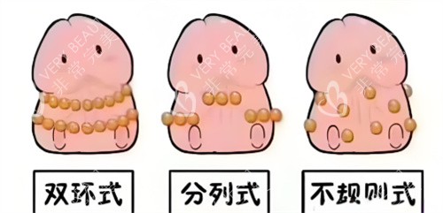 入珠手術(shù)動(dòng)畫3