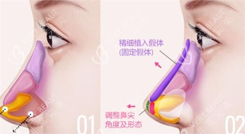 鼻尖假體植入位置