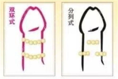 陰莖入珠術(shù)款式有哪些