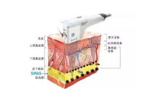 激光祛紅血絲示意圖