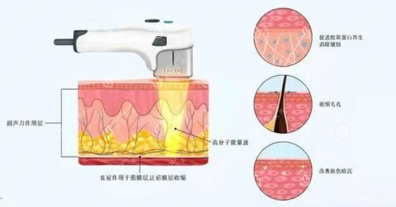 美版超聲提拉