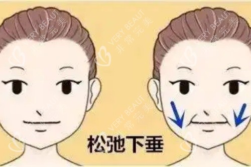 嘴角松弛下垂對比圖