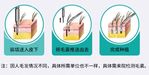 植發(fā)過程示意圖片