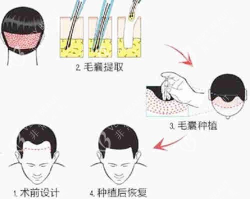 植發(fā)過程圖解詳細
