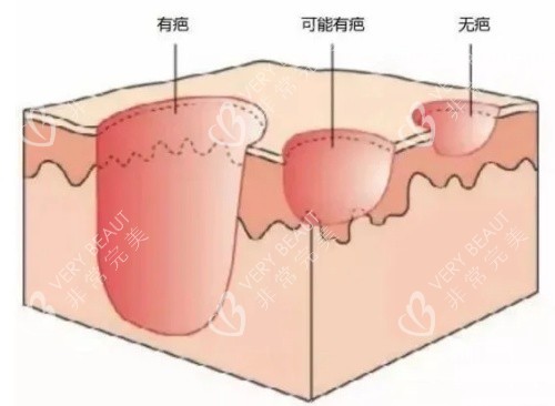 有疤無疤立體圖片