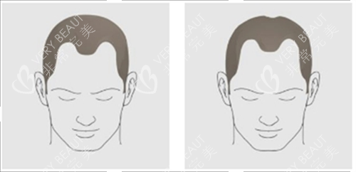 發(fā)際線后移類型