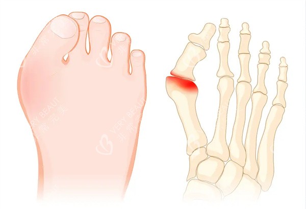 大腳骨矯正術
