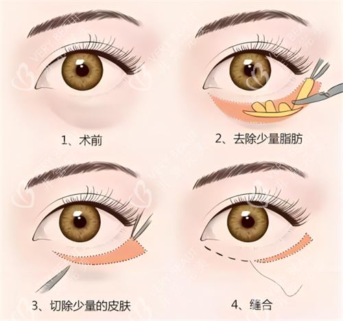 想找广州黄志祥做眼整形？先看他的擅长项目、手术风格及术后口碑，避坑指南附后