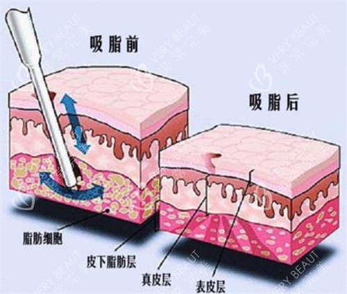 吸脂手術(shù)前后對(duì)比動(dòng)畫(huà)圖示