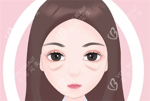 眼袋圖