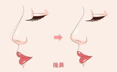 隆鼻對比圖