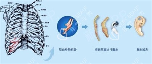 耳再造手術(shù)肋軟骨雕刻