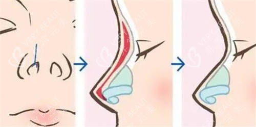 武漢楊水斌醫(yī)生隆鼻手術(shù)過(guò)程