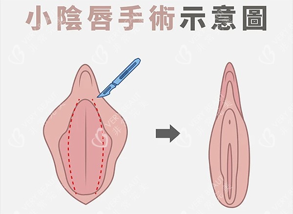 小陰唇整形前后對比