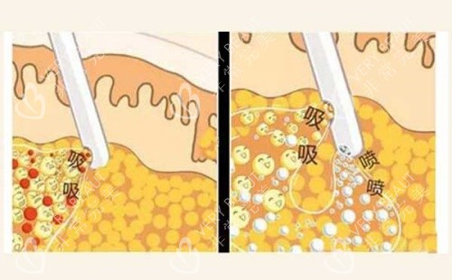 吸脂操作示意圖
