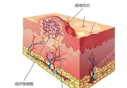 鼻綜合假體植入