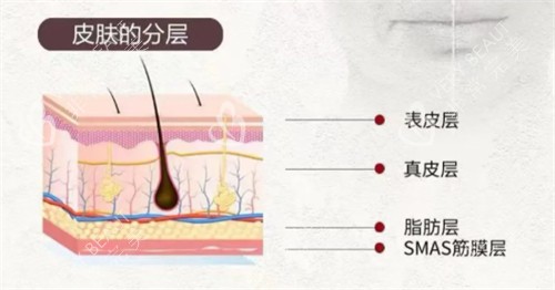 softwave索夫波適用皮膚層次