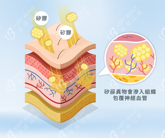 饅化針注射示意圖