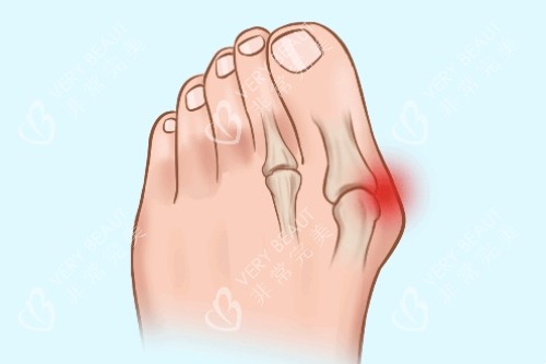 大腳骨疼痛卡通圖