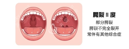 二度唇腭裂示意圖