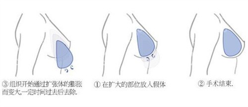 隆胸手術(shù)過(guò)程