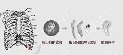 肋软骨耳再造支架.webp