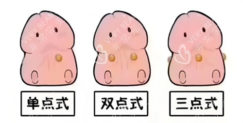 入珠手术动画