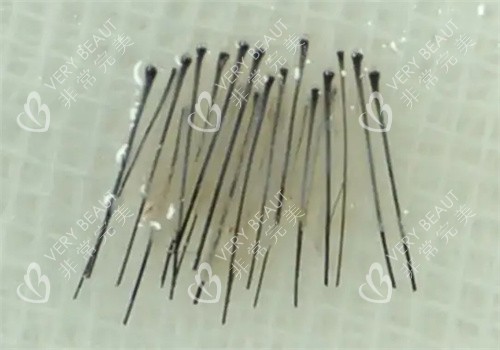 毛囊處理照片