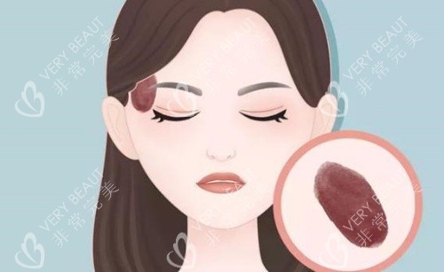 臉上胎記示意圖