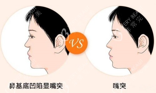 鼻基底凹陷嘴凸示意圖