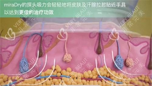 miraDry清新微波是什么