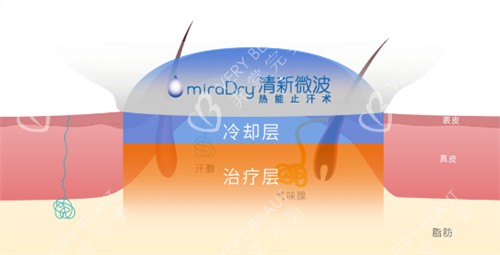 miraDry清新微波作用层次
